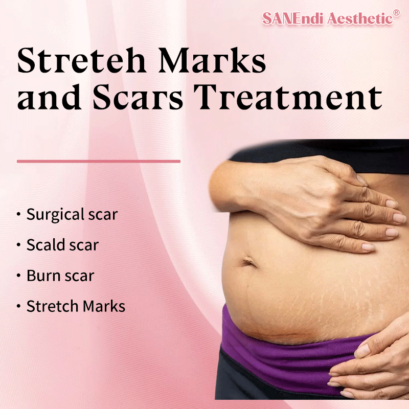 Stretch Marks & Scars Treatment