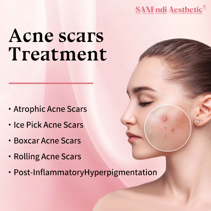 Acne scars Treatment