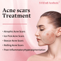 Acne scars Treatment
